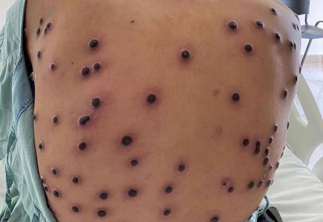 Números alarmantes: surto de mpox atinge o Brasil em 2026, com São Paulo liderando os casos.